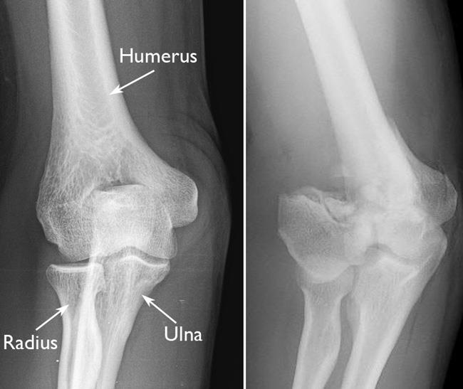 X-rays of a normal elbow and a displaced elbow fracture