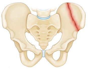 Pelvic Fractures - OrthoInfo - AAOS