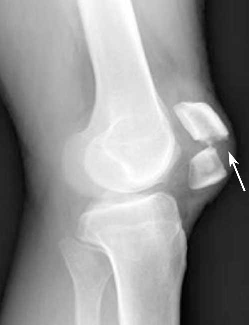 x-ray of patellar fracture with significant displacement