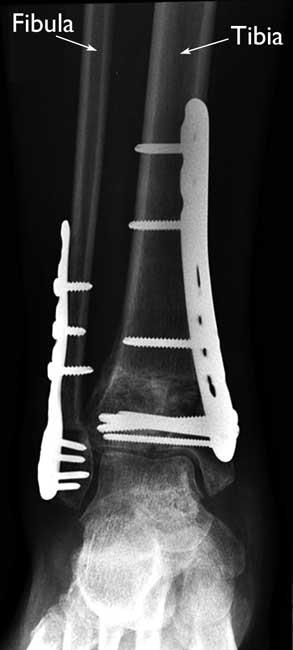Internal fixation of a pilon fracture
