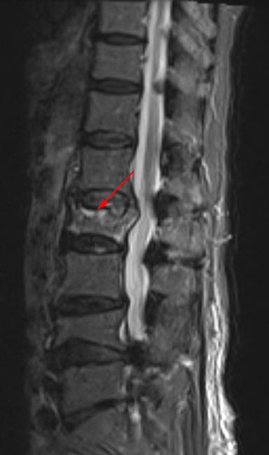 MRI of a fractured vertebra showing edema