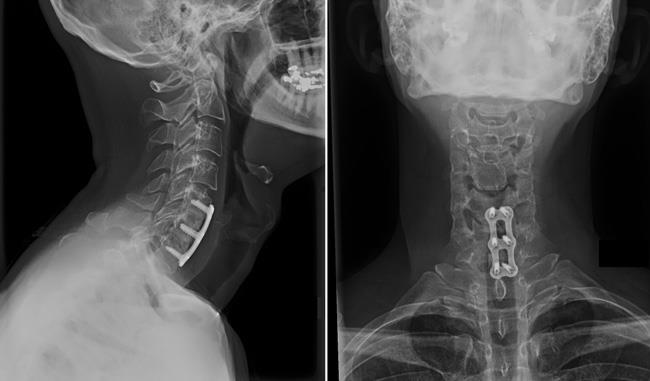 X-rays showing anterior cervical diskectomy and spinal fusion 