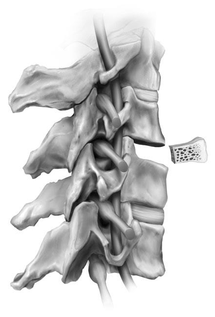 Illustration of a bone graft