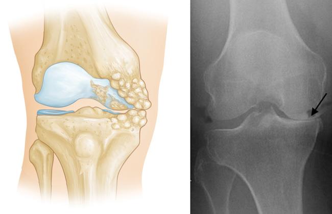 illustration of osteoarthritis limited to medial compartment; x-ray of osteoarthritis in medial compartment