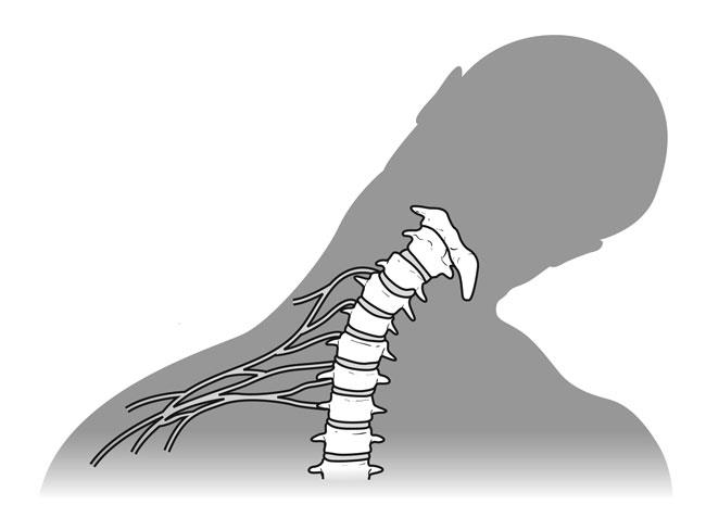 how brachial plexus injuries occur