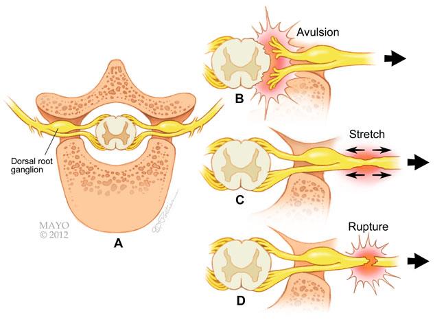 Cross-section views of the major types of brachial plexus stretch injuries