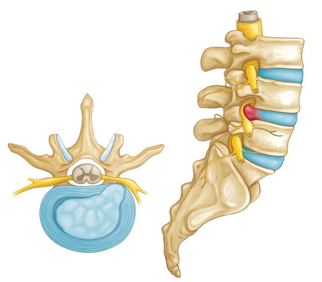 Una hernia de disco (vista lateral y corte transversal). 