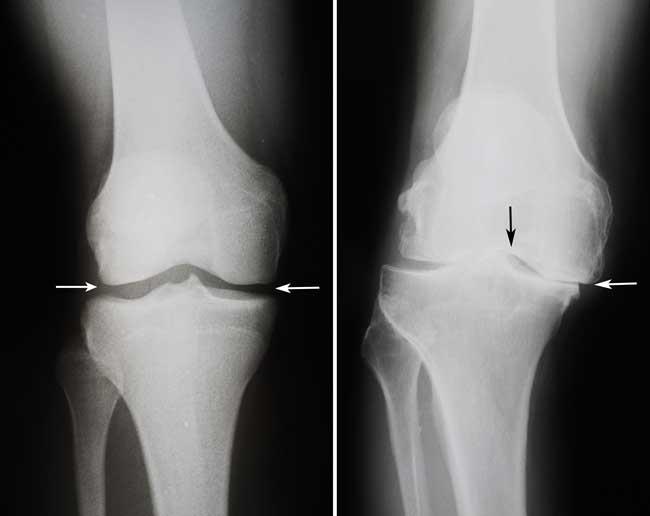 (Esquerda) Nesta radiografia de um joelho normal, o espaço entre os ossos indica uma cartilagem saudável (setas). (Direita) Esta radiografia de um joelho que ficou arqueado pela artrose mostra perda grave de espaço articular (setas). 
