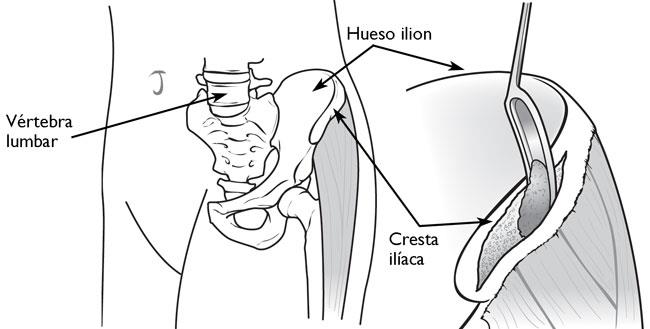 La mayoría de los autoinjertos se cosechan de la cresta ilíaca de la cadera. 
