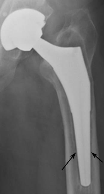 X-ray of implant loosening
