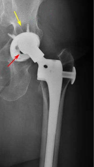 X-ray of loose acetabular cup