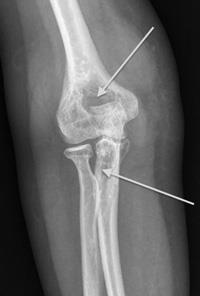 X-ray showing destruction of bone in an elbow with PVNS