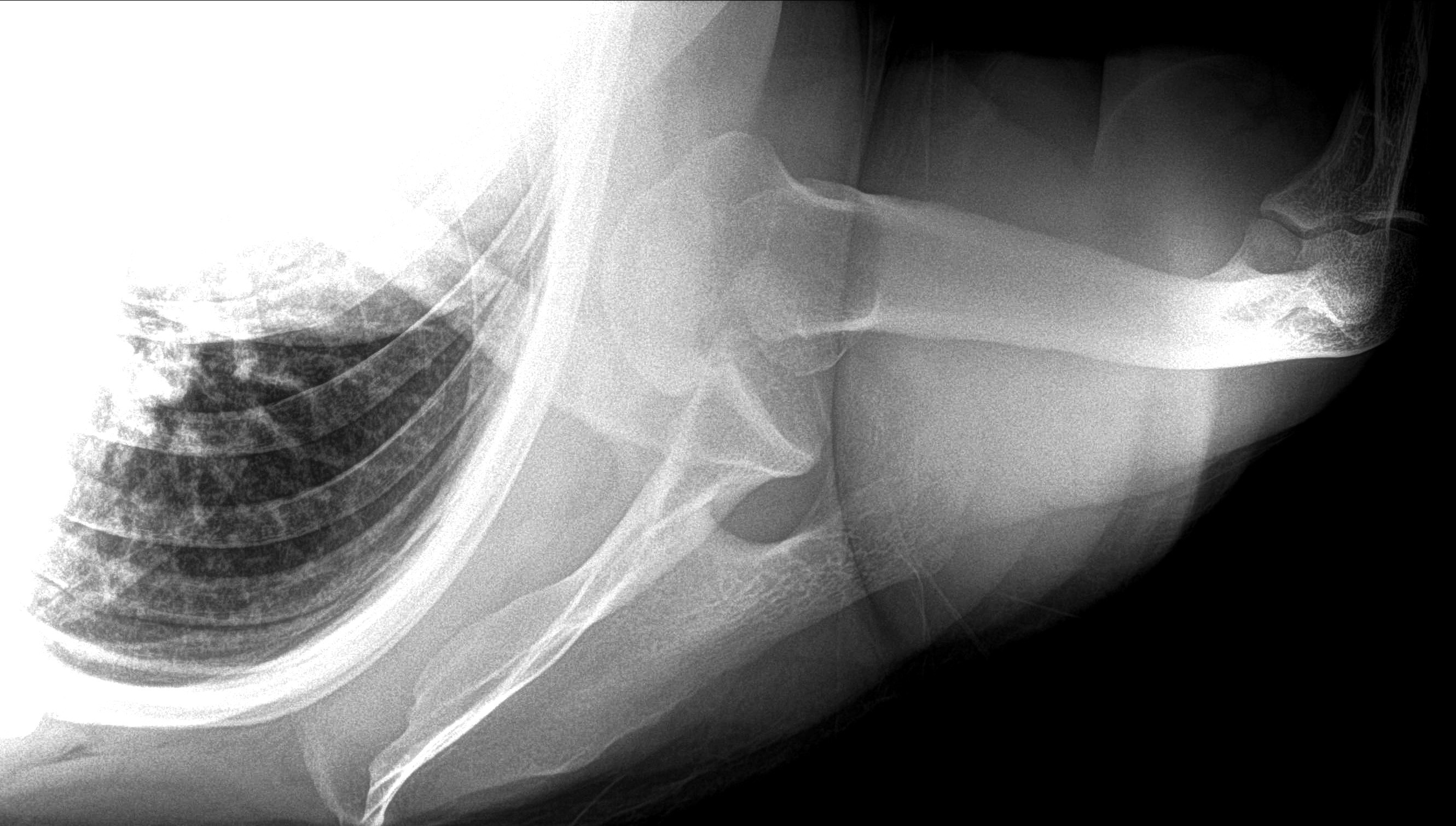 X-ray of Anterior Dislocation of Shoulder