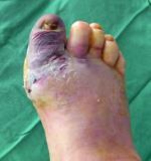 infected big toe