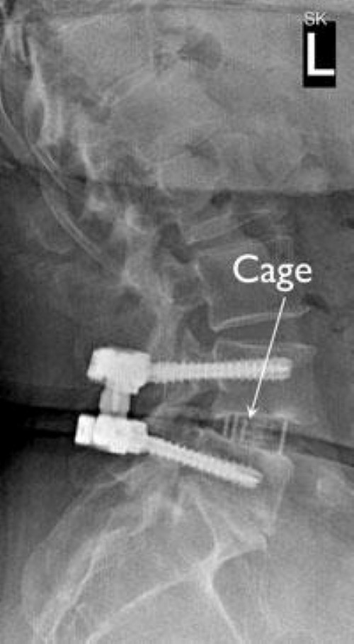 x-ray of cage and screws for interbody fusion