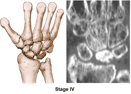 Kienböck's disease stage 4