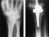 Wrist joint replacement