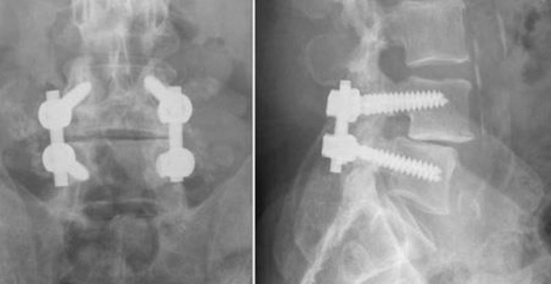Back and side views of posterolateral fusion with screws.