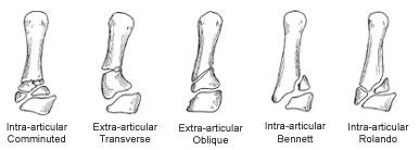 Classification of them fractures