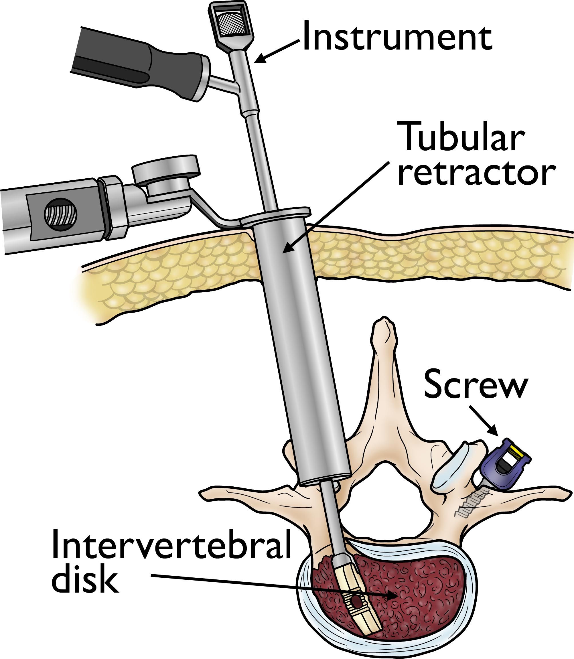 Tubular retractor used in a spine procedure