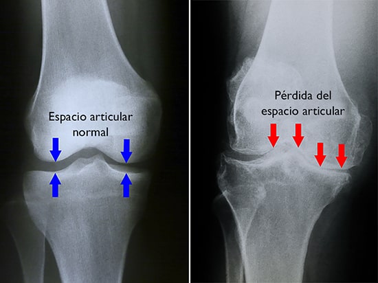 normal and arthritic knee