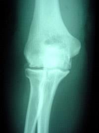 osteoarthritis of the elbow