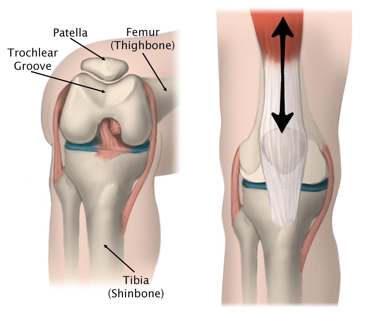 Illustration of the movement of the patella in the trochlear groove