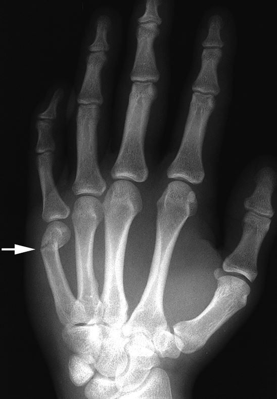 X-ray of a "boxer's fracture"