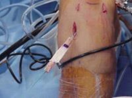 Passage of patellar tendon graft during ACL reconstruction