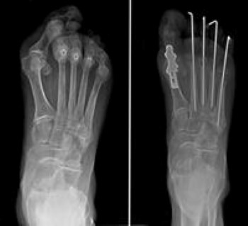 RA of the forefoot before and after fusion