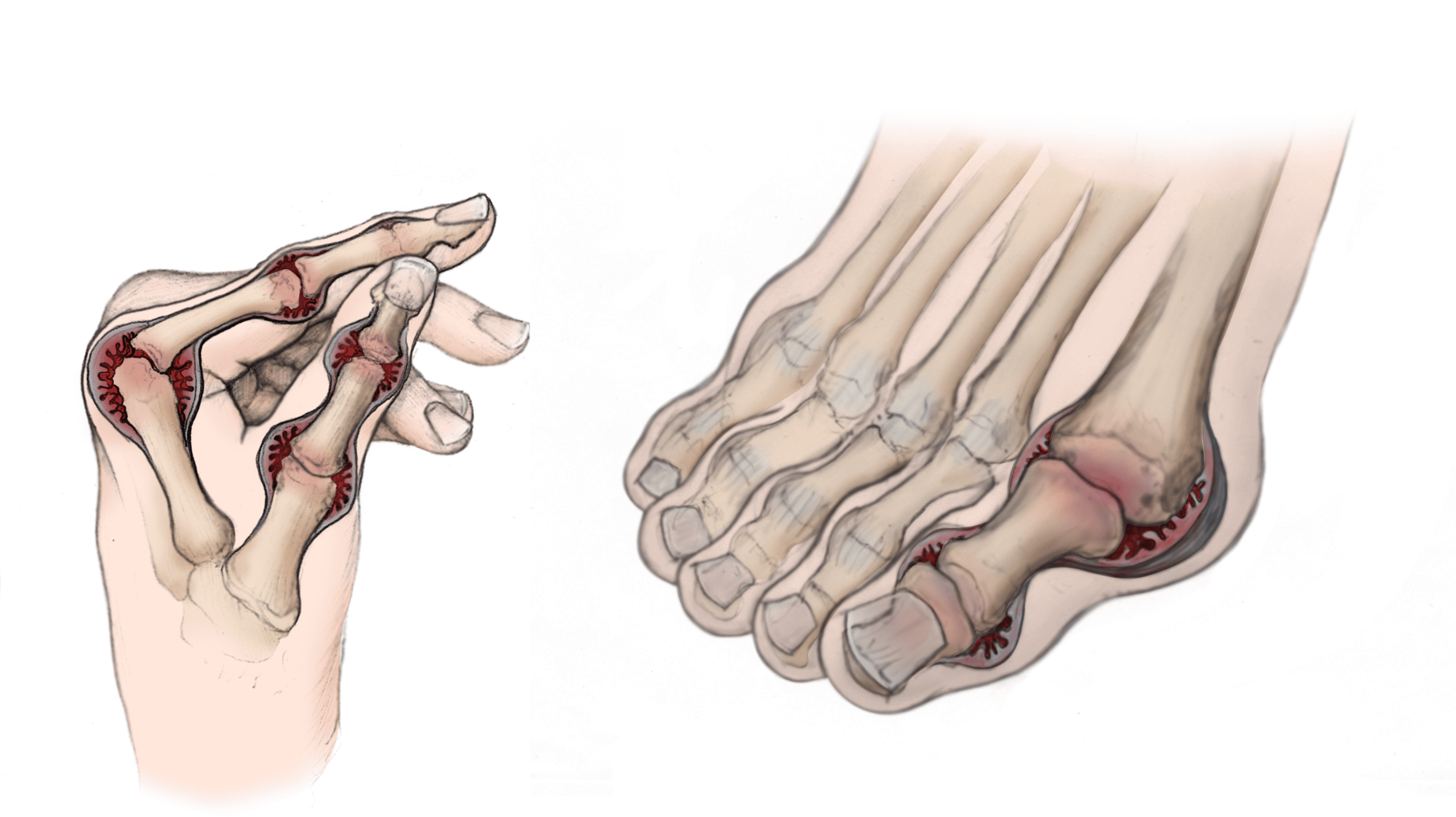 Rheumatoid Arthritis in the Hand and Foot