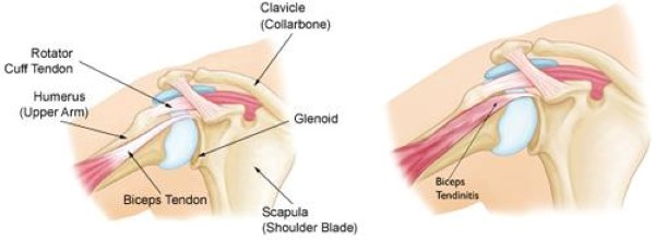biceps tendinitis