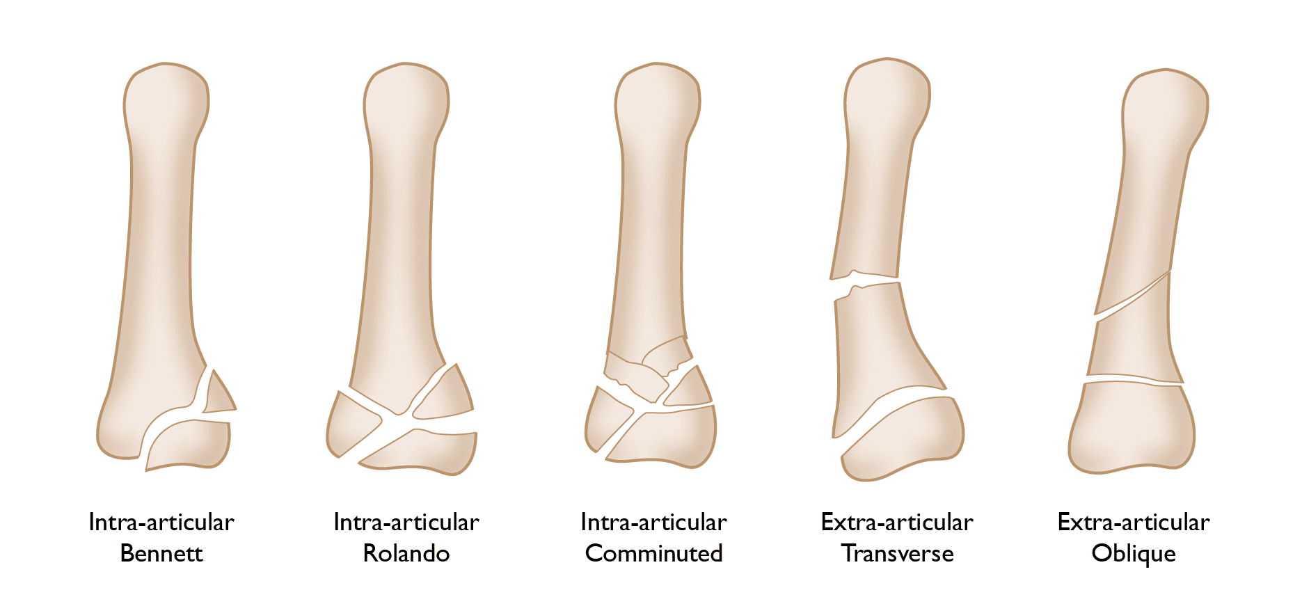 Classification of them fractures