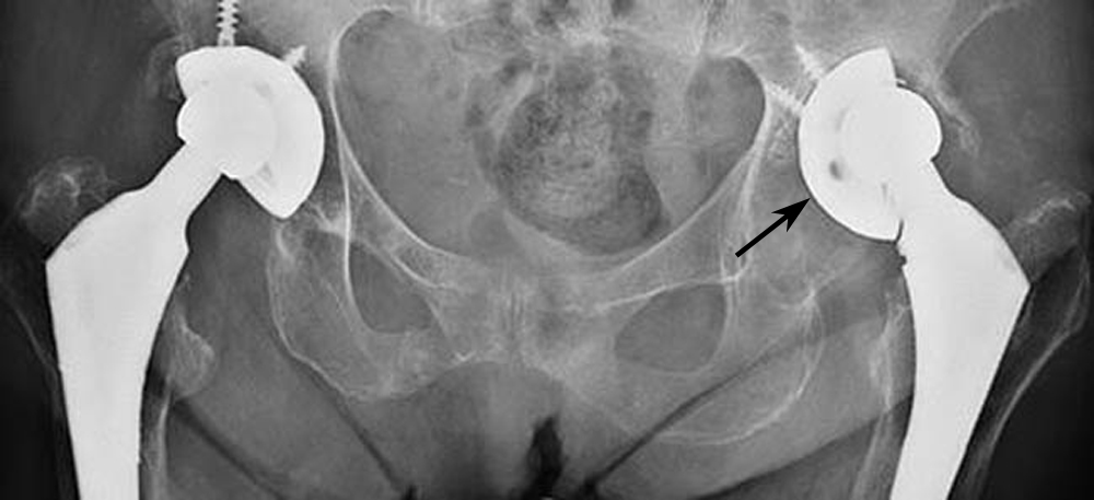 X-ray of loose acetabular cup