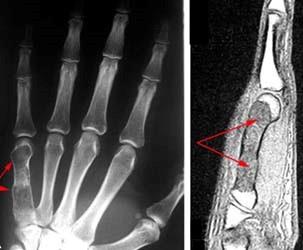 X-ray and MRI of enchondroma in the hand