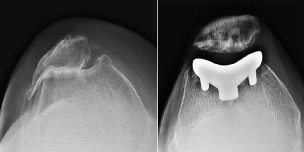 X-rays of arthritic knee and patellofemoral replacement