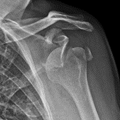 Shoulder Dislocation With Multiple Fractures