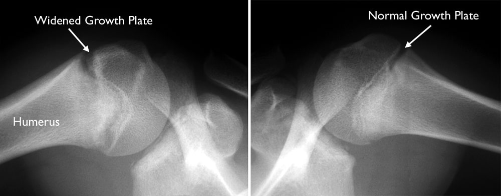 x-rays of normal and widened growth plates in shoulder
