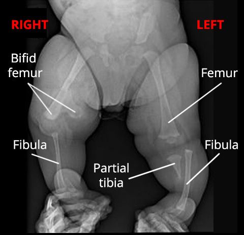 X-ray of tibial hemimelia