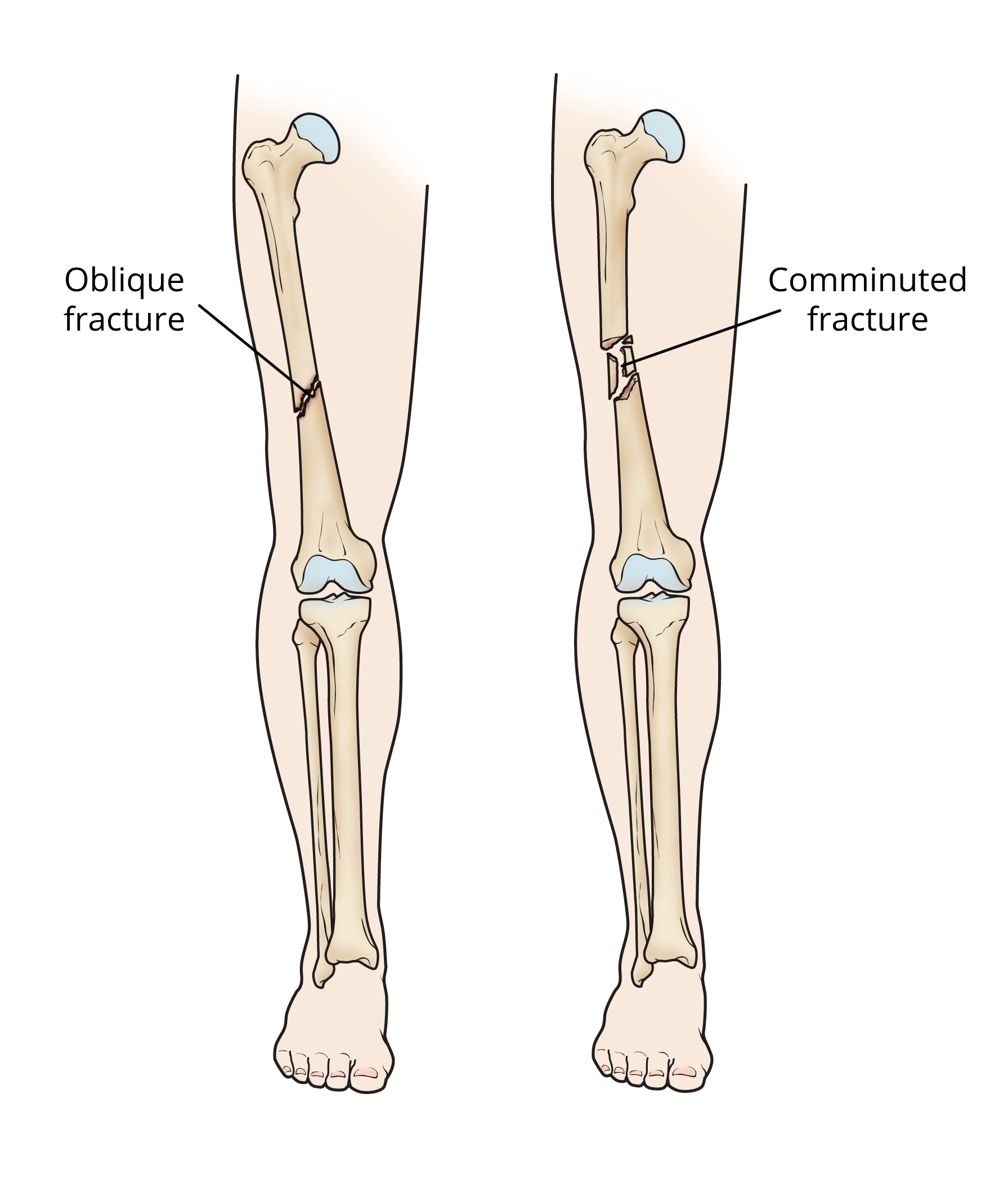 types of femur (thighbone) fractures
