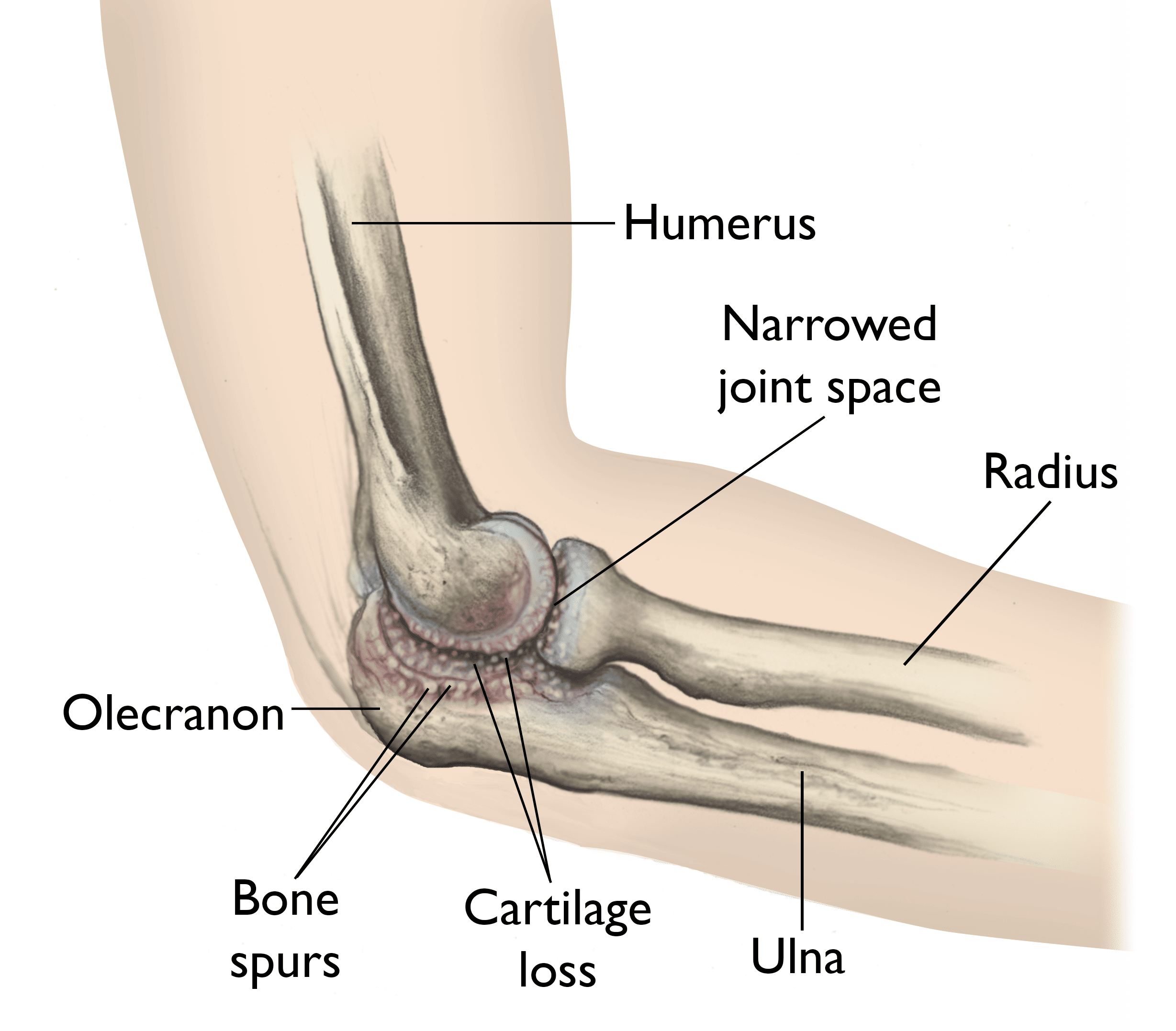 Elbow With Osteoarthritis