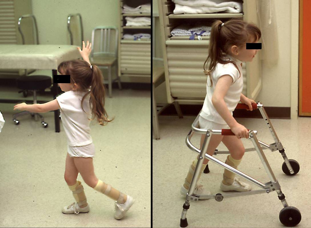 Young girl with cerebral palsy