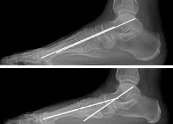X-ray of flatfoot