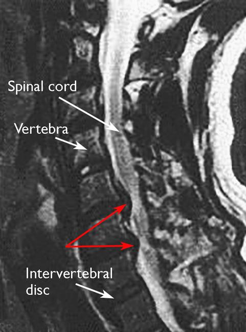 MRI scan of a herniated disk pressing on spinal cord