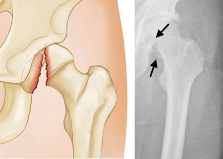 fracture of the femoral head