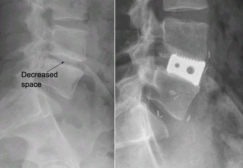 X-rays of decreased disk space and ALIF