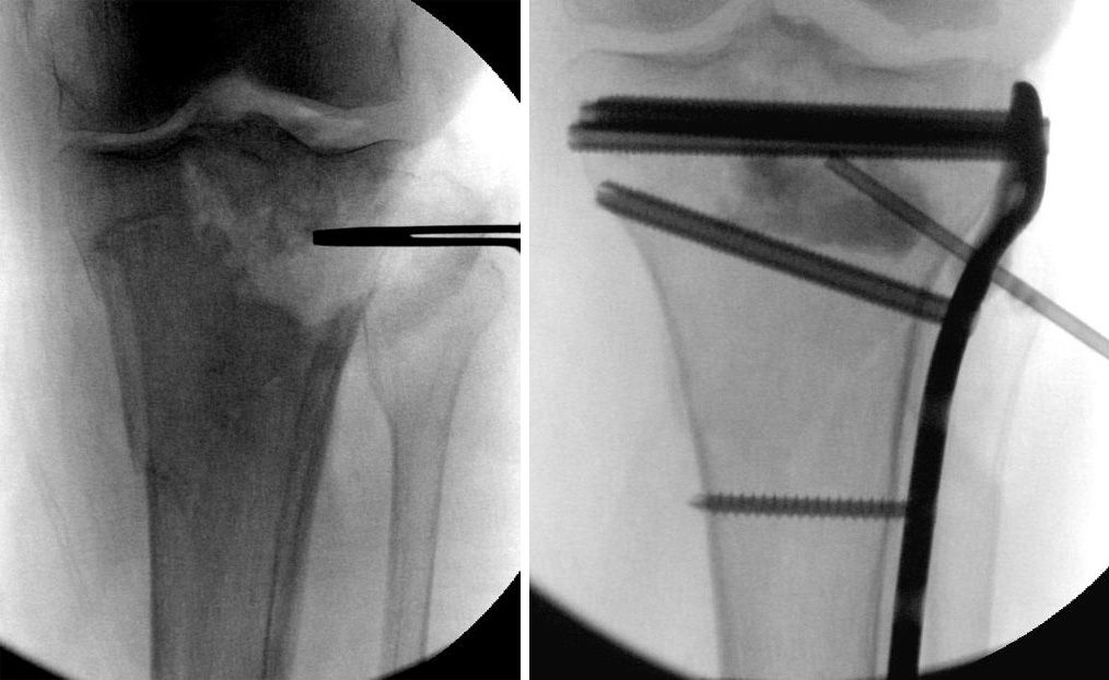 Internal fixation of proximal tibia fracture