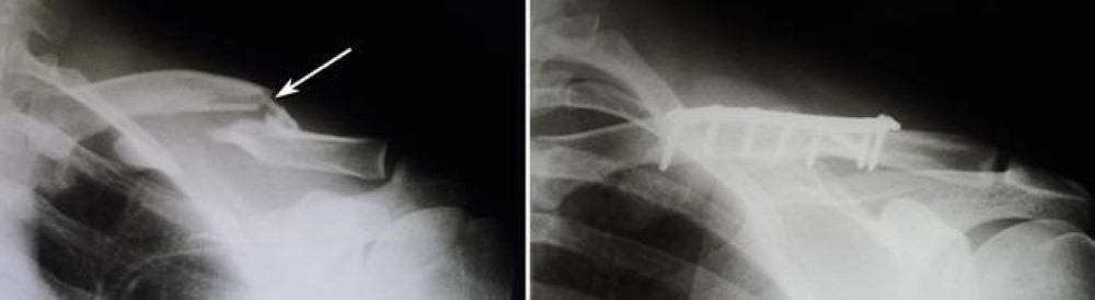 Internal fixation of clavicle fracture
