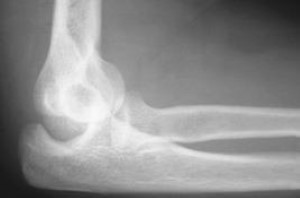 Partial elbow dislocation (subluxation)
