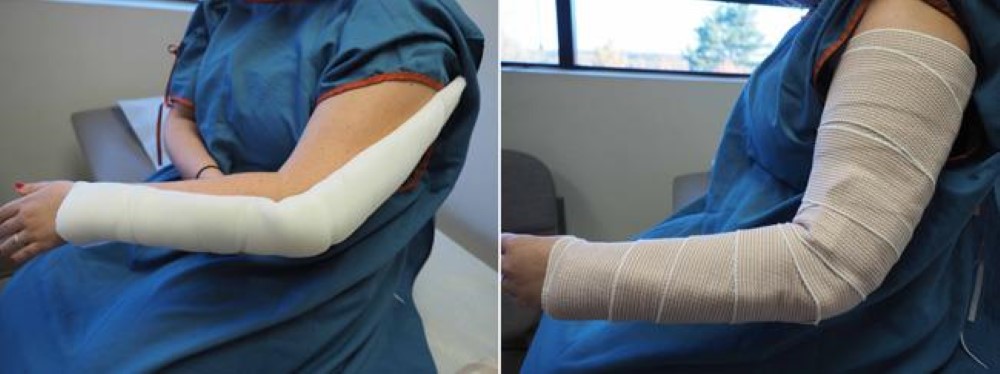 Patient wearing an elbow splint